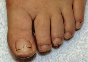 Bøjlebehandling (ortonyxi) af FeetCare